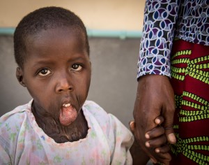 Mabel - Cirugía en Turkana 2015